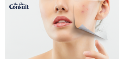 Tips to Avoid Acne Problems in PCOS