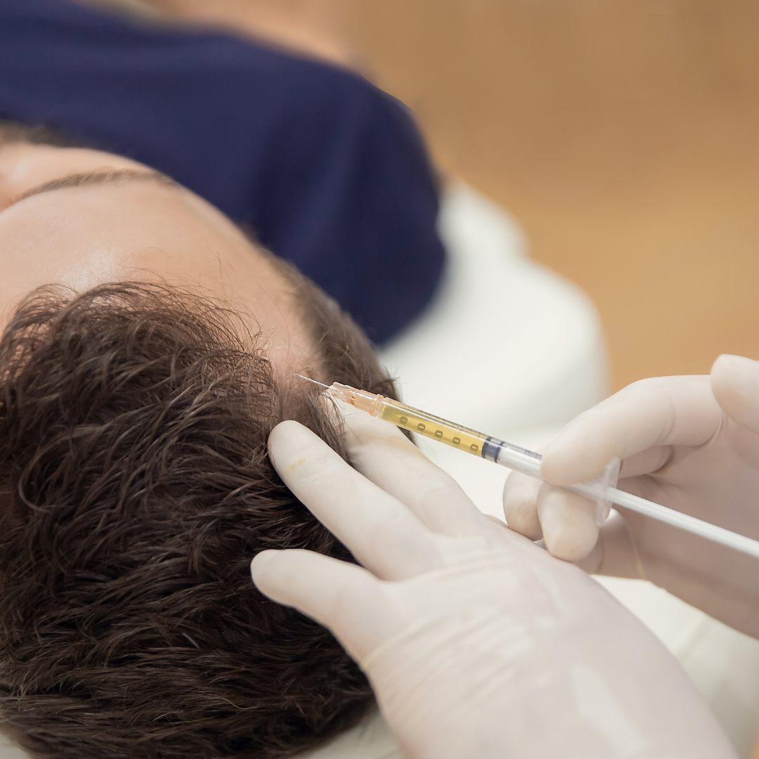 Hair Loss Injection Therapy- steroid